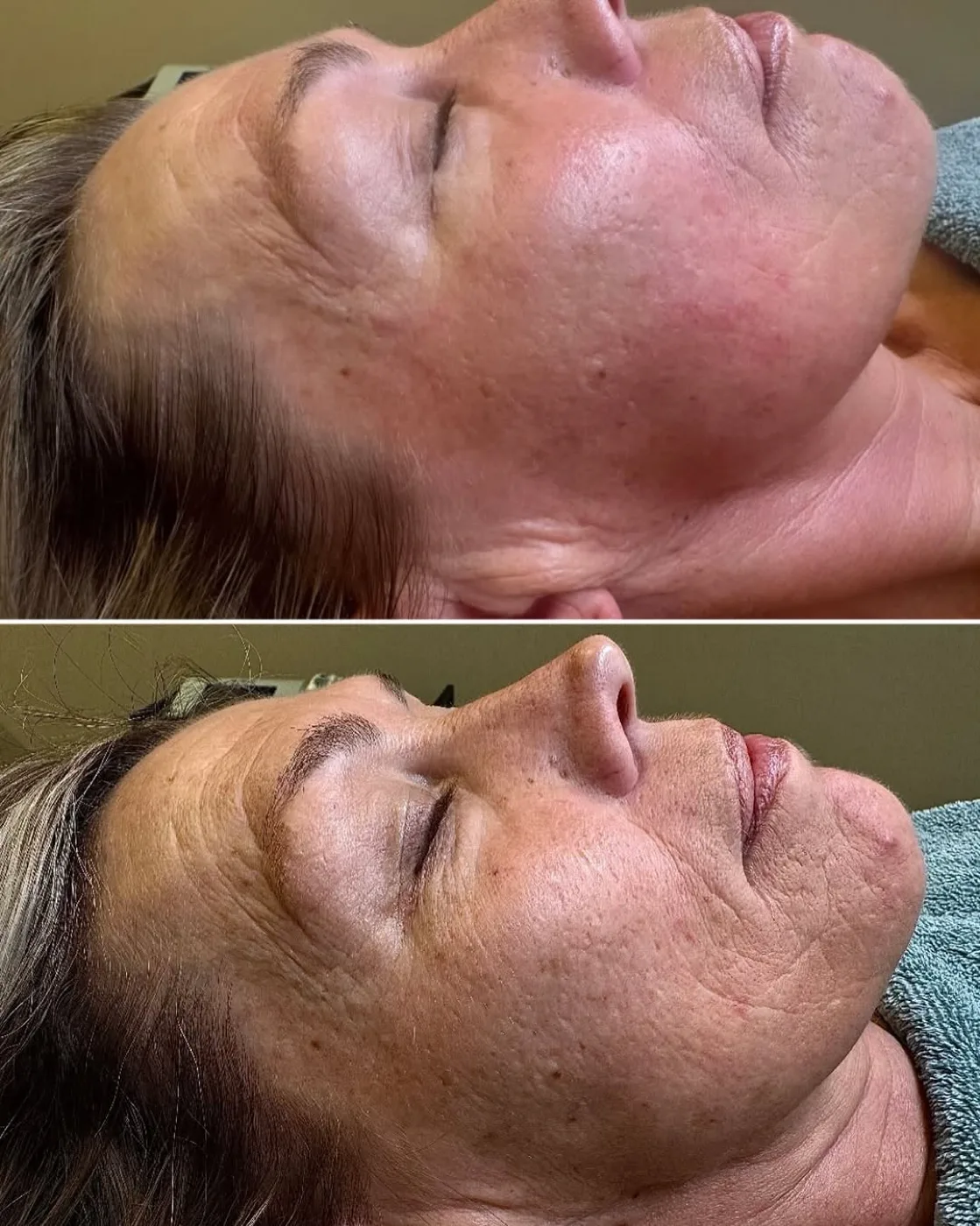 Résultat avant et après une séance — pommettes et ovale du visage
